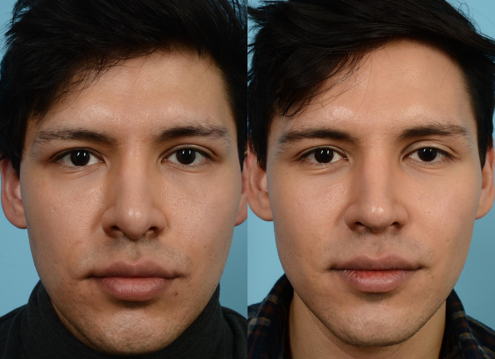 Before & After Revision Rhinoplasty by Dr. Mustoe Case 938 Front View in Chicago, IL