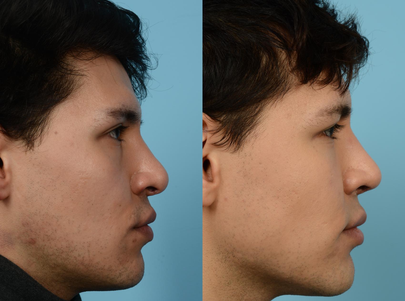 Before & After Revision Rhinoplasty by Dr. Mustoe Case 938 Right Side View in Chicago, IL