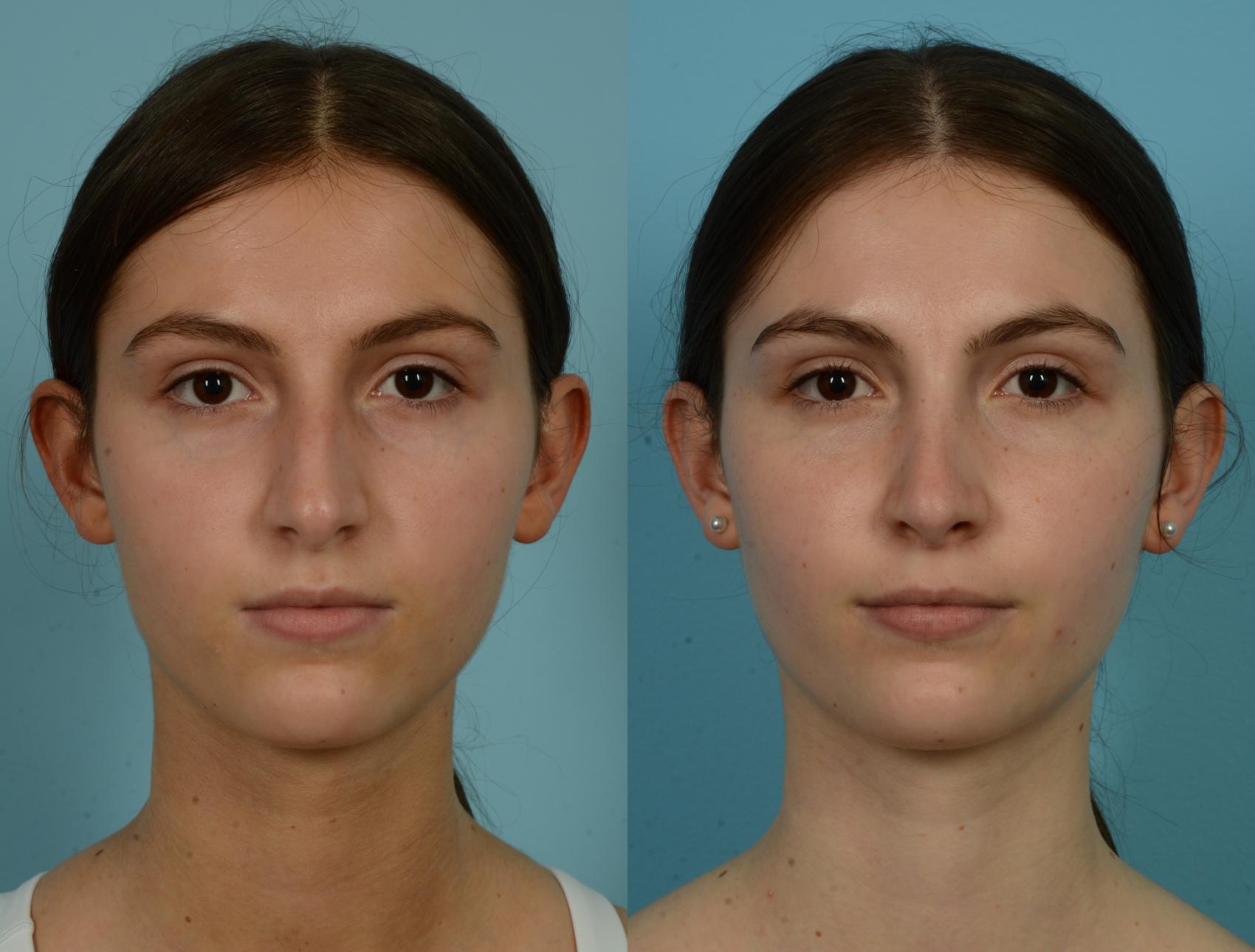 Before & After Rhinoplasty by Dr. Mustoe Case 1050 Front View in Chicago, IL