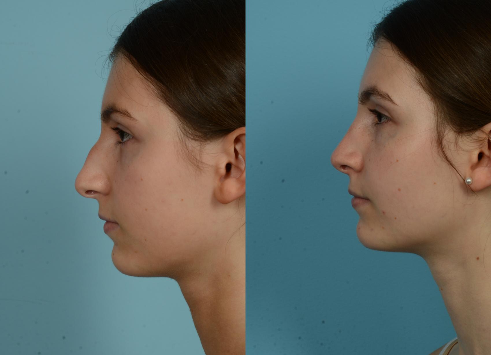 Before & After Rhinoplasty by Dr. Mustoe Case 1050 Left Side View in Chicago, IL