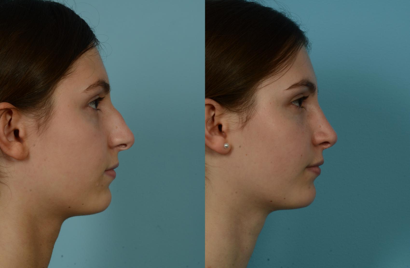 Before & After Rhinoplasty by Dr. Mustoe Case 1050 Right Side View in Chicago, IL