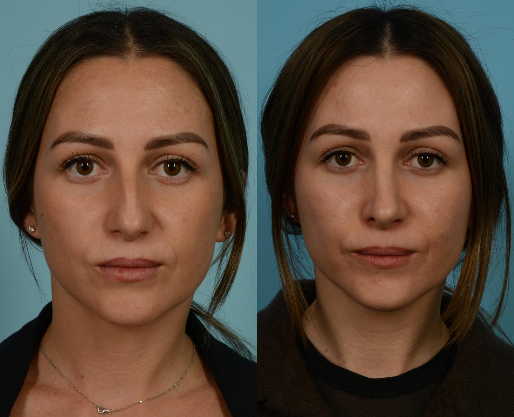 Before & After Rhinoplasty by Dr. Mustoe Case 1055 Front View in Chicago, IL