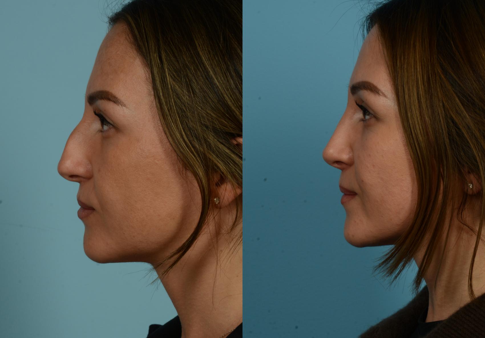 Before & After Rhinoplasty by Dr. Mustoe Case 1055 Left Side View in Chicago, IL