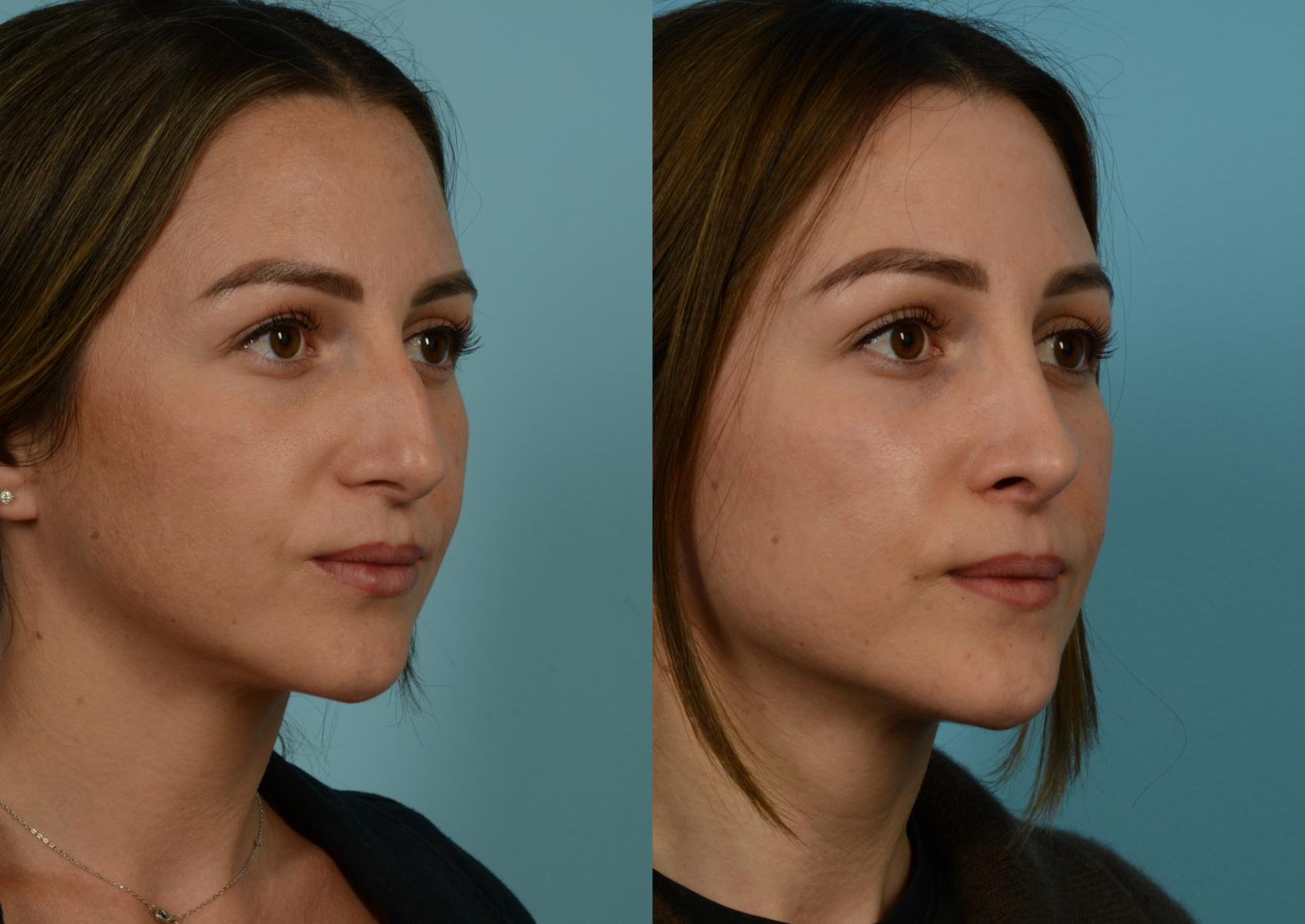 Before & After Rhinoplasty by Dr. Mustoe Case 1055 Right Oblique View in Chicago, IL