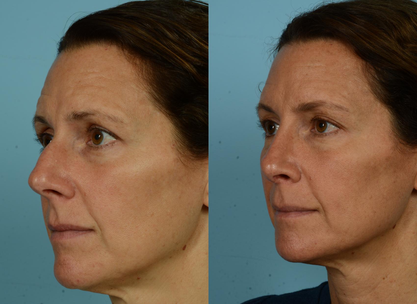 Before & After Rhinoplasty by Dr. Mustoe Case 1077 Left Oblique View in Chicago, IL