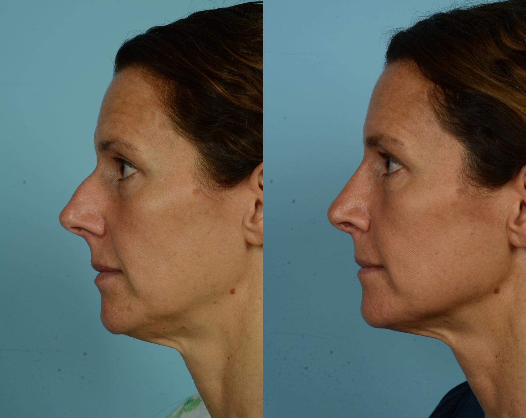 Before & After Rhinoplasty by Dr. Mustoe Case 1077 Left Side View in Chicago, IL