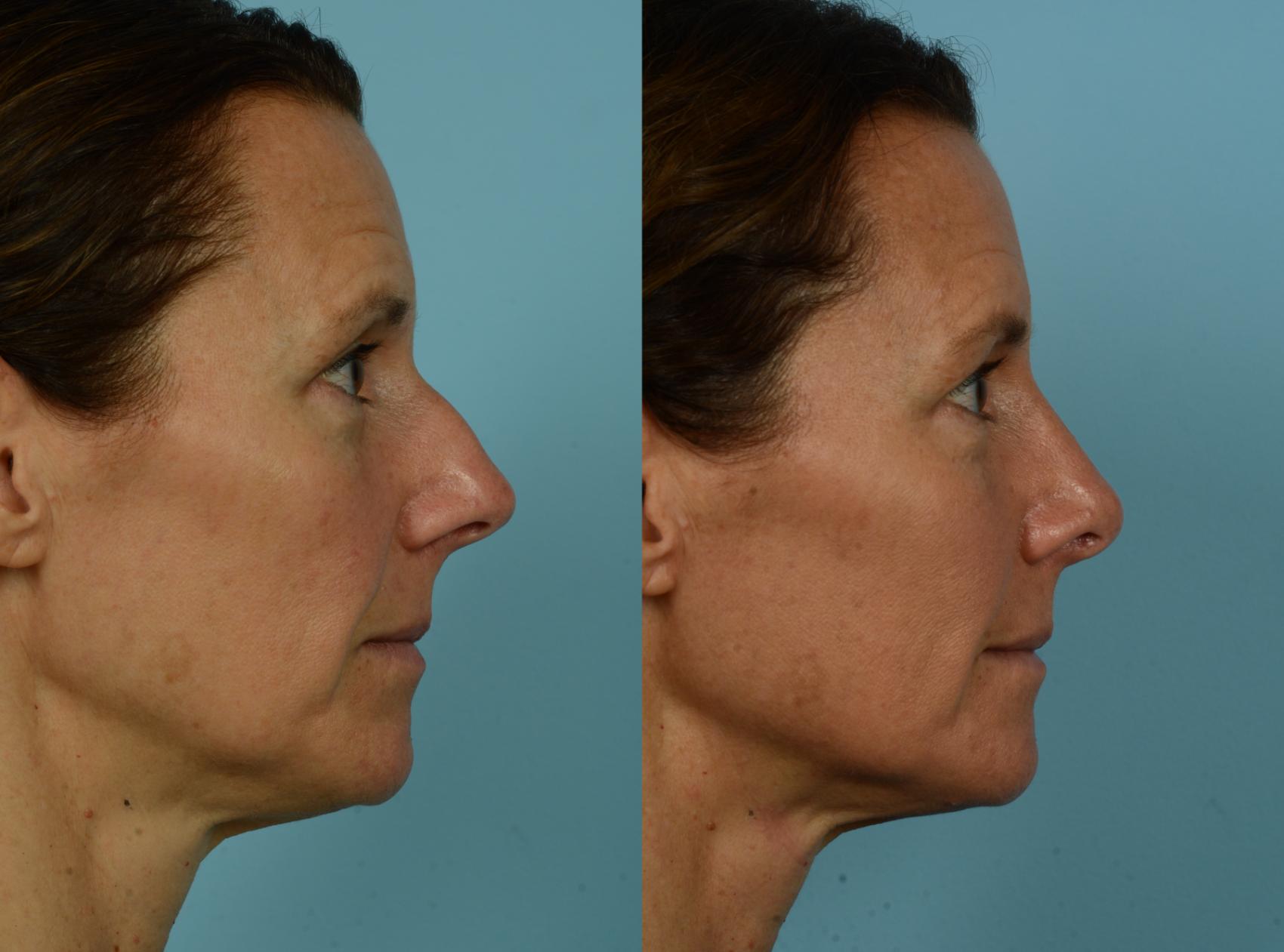 Before & After Rhinoplasty by Dr. Mustoe Case 1077 Right Side View in Chicago, IL