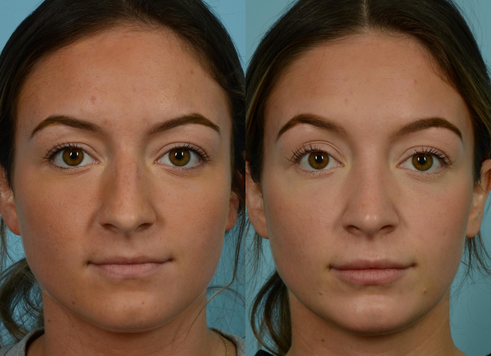 Before & After Rhinoplasty by Dr. Mustoe Case 1078 Front View in Chicago, IL