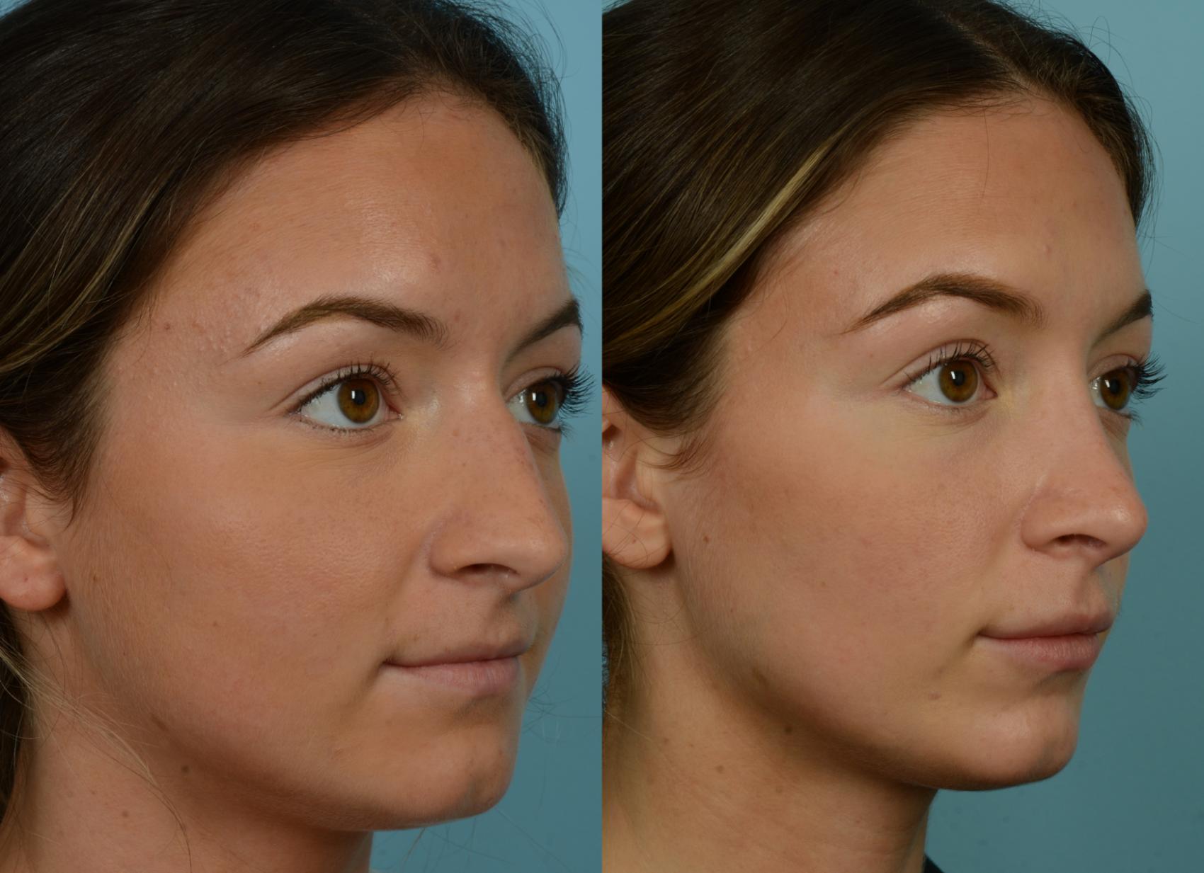Before & After Rhinoplasty by Dr. Mustoe Case 1078 Left Oblique View in Chicago, IL