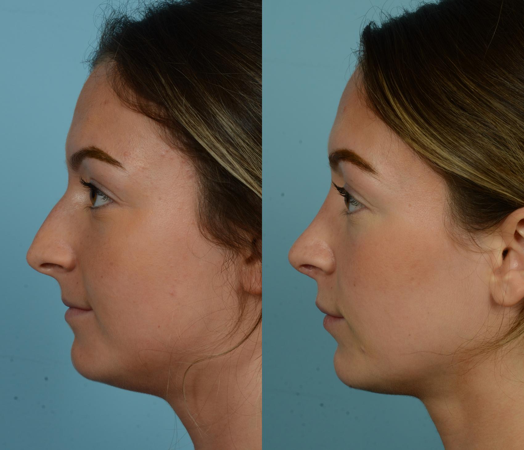 Before & After Rhinoplasty by Dr. Mustoe Case 1078 Left Side View in Chicago, IL