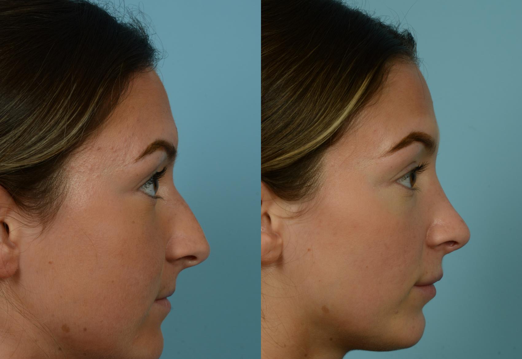 Before & After Rhinoplasty by Dr. Mustoe Case 1078 Right Side View in Chicago, IL