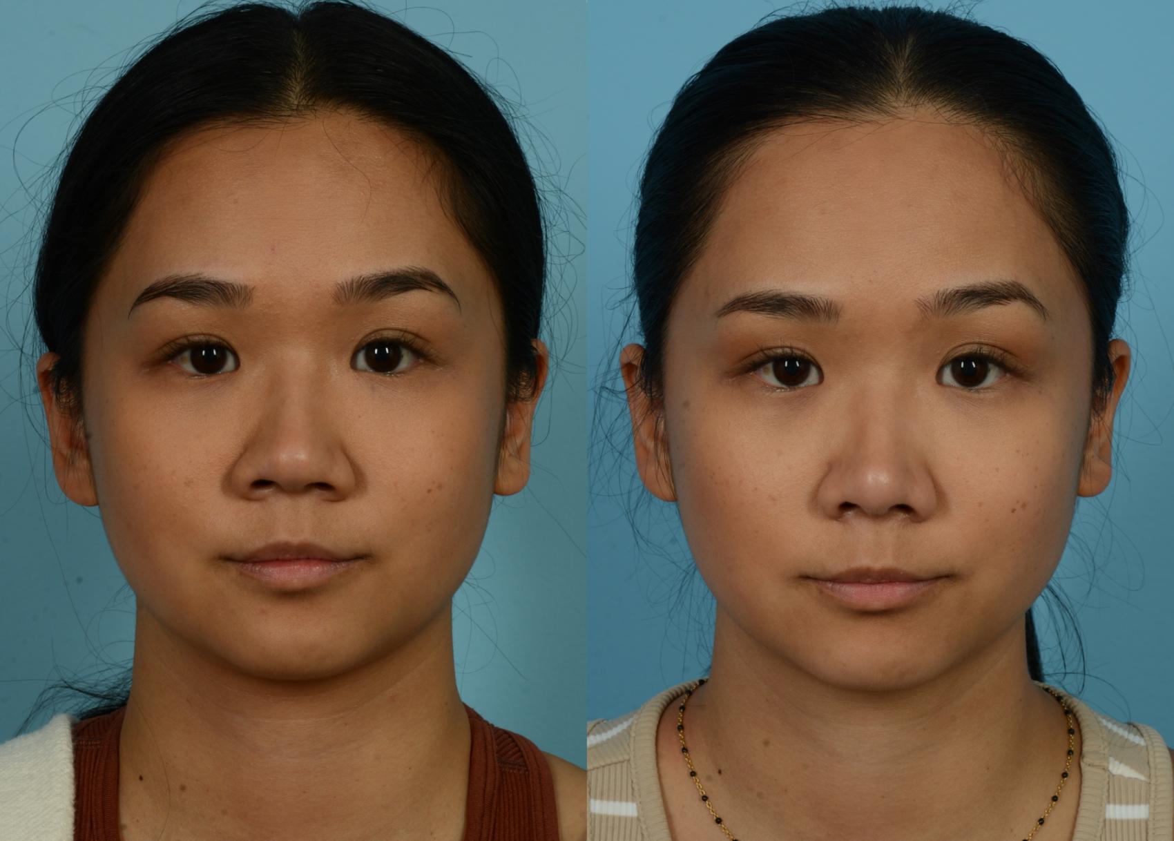 Before & After Rhinoplasty by Dr. Mustoe Case 1087 Front View in Chicago, IL
