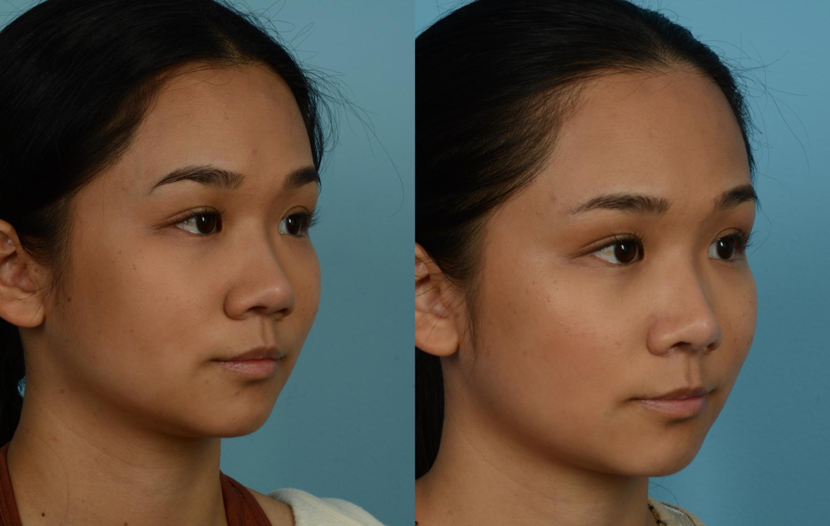 Before & After Rhinoplasty by Dr. Mustoe Case 1087 Right Oblique View in Chicago, IL