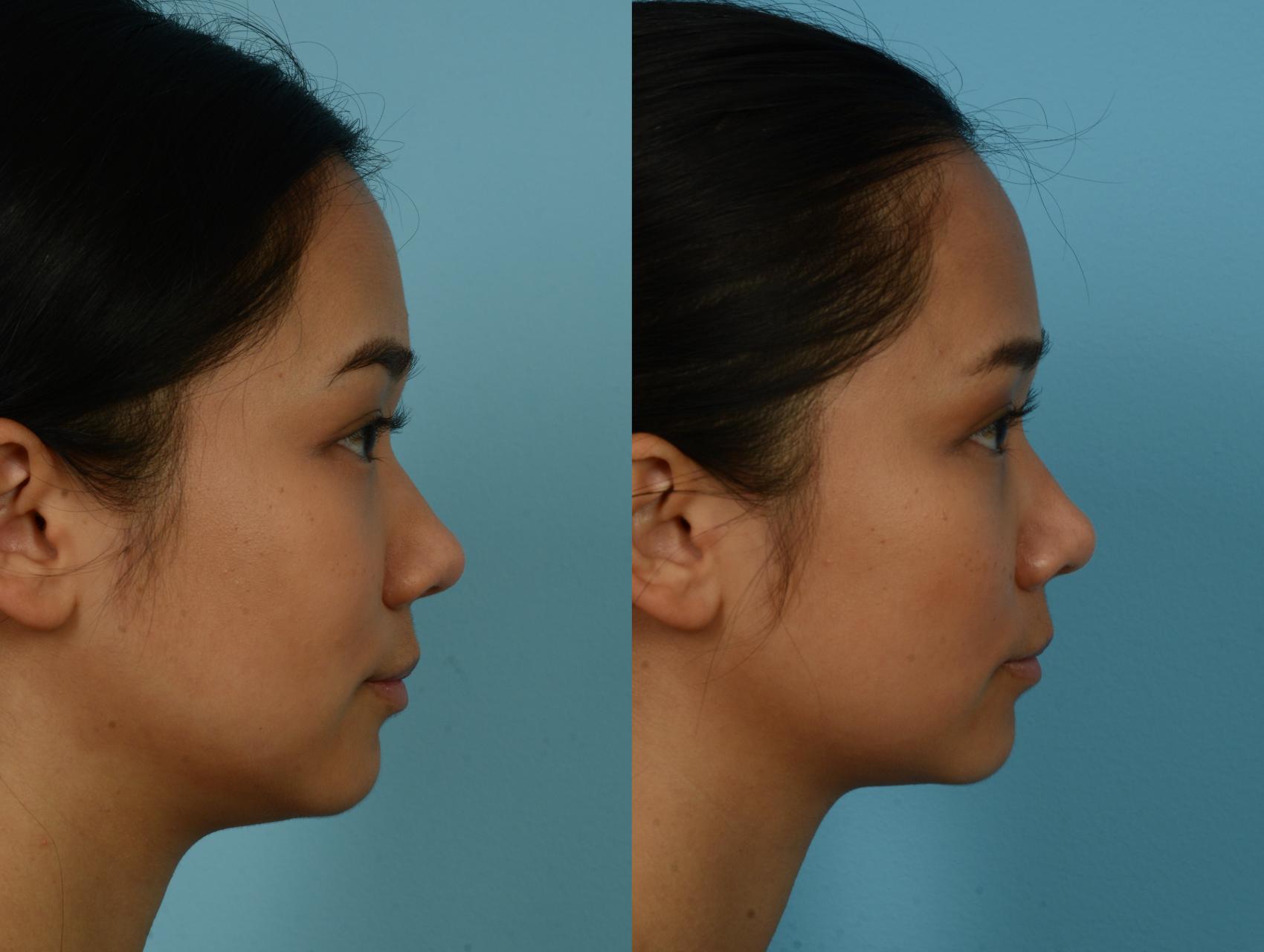 Before & After Rhinoplasty by Dr. Mustoe Case 1087 Right Side View in Chicago, IL