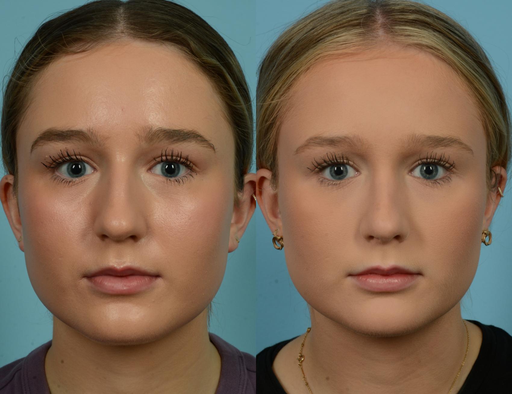 Before & After Rhinoplasty by Dr. Mustoe Case 1089 Front View in Chicago, IL