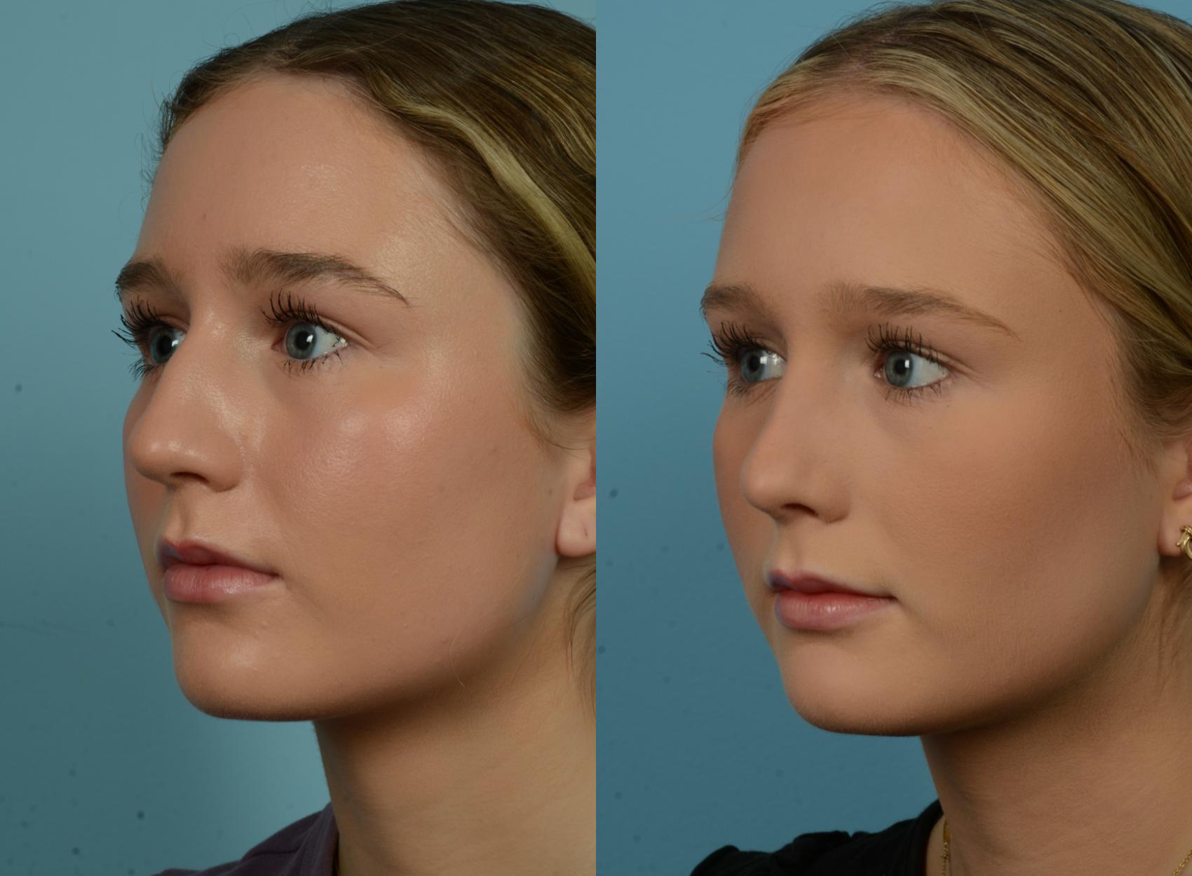 Before & After Rhinoplasty by Dr. Mustoe Case 1089 Left Oblique View in Chicago, IL