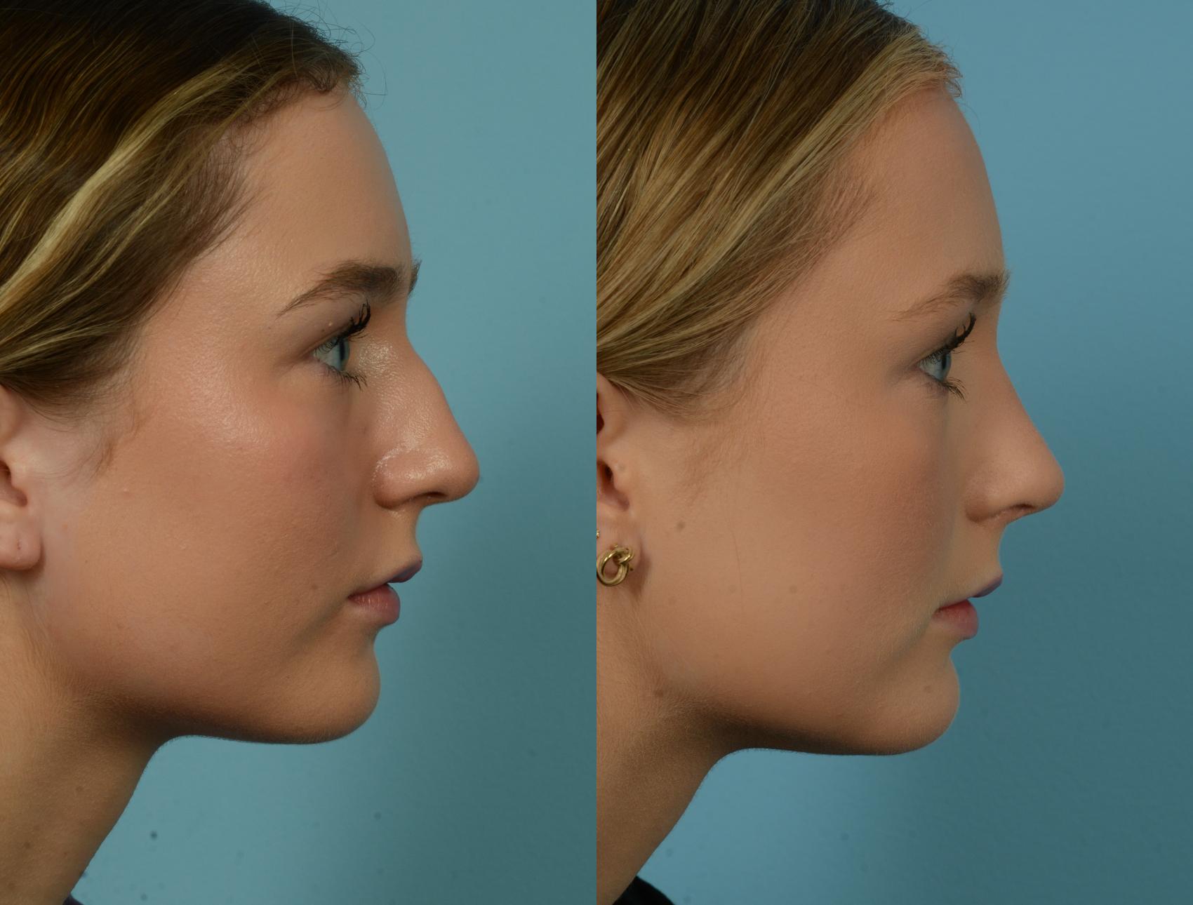 Before & After Rhinoplasty by Dr. Mustoe Case 1089 Right Side View in Chicago, IL