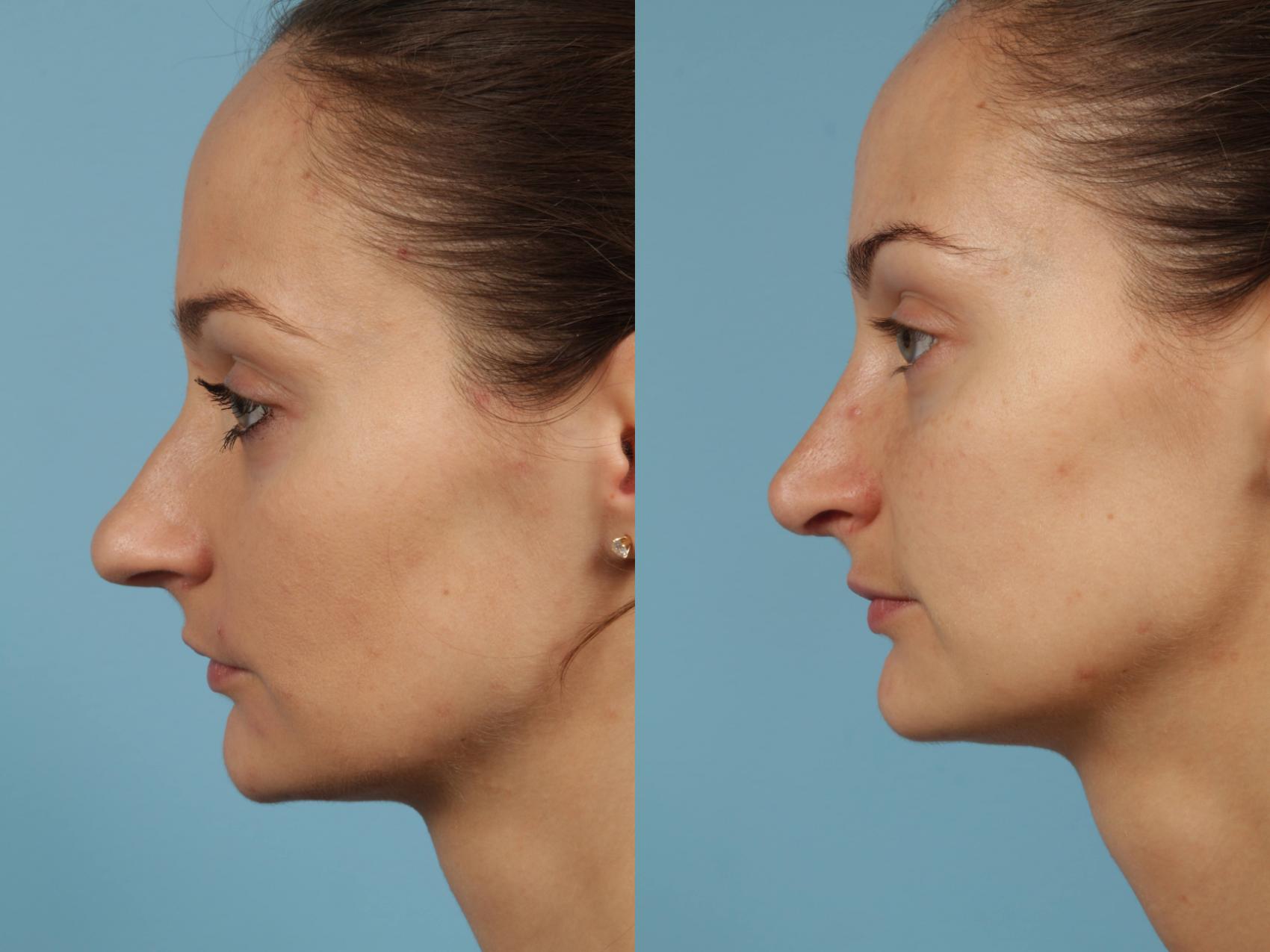 Before & After Rhinoplasty by Dr. Mustoe Case 187 View #1 View in Chicago, IL