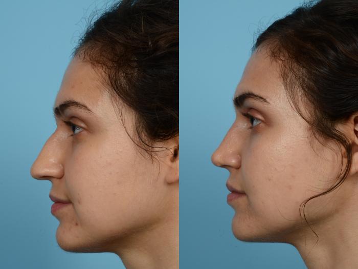 Before & After Rhinoplasty by Dr. Mustoe Case 496 View #1 View in Chicago, IL
