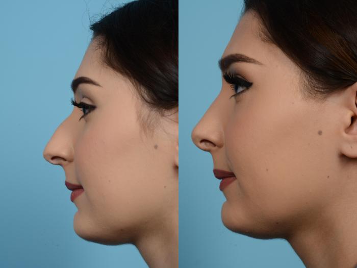 Before & After Rhinoplasty by Dr. Mustoe Case 526 View #1 View in Chicago, IL