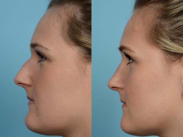 Before & After Rhinoplasty by Dr. Mustoe Case 588 Left Side View in Chicago, IL