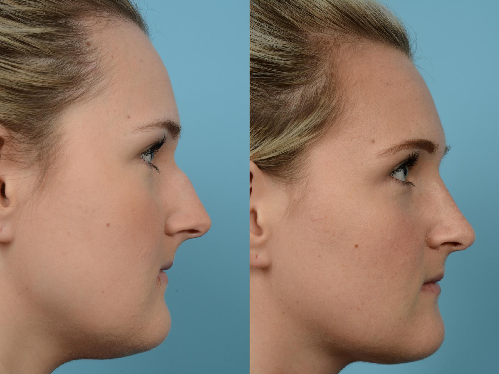 Rhinoplasty By Dr Mustoe Before And After Pictures Case Chicago