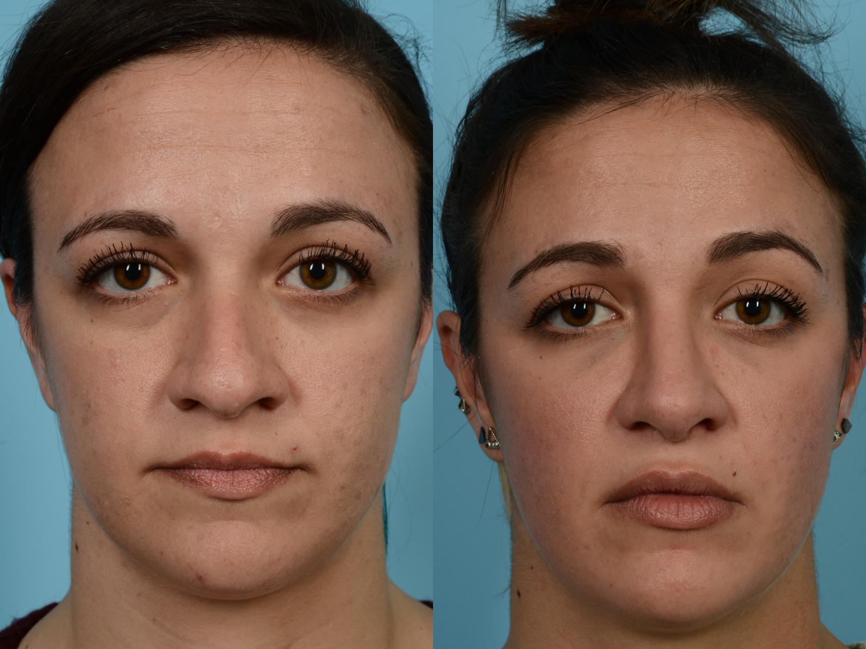 Dr. Sinno Rhinoplasty in Chicago, Illinois