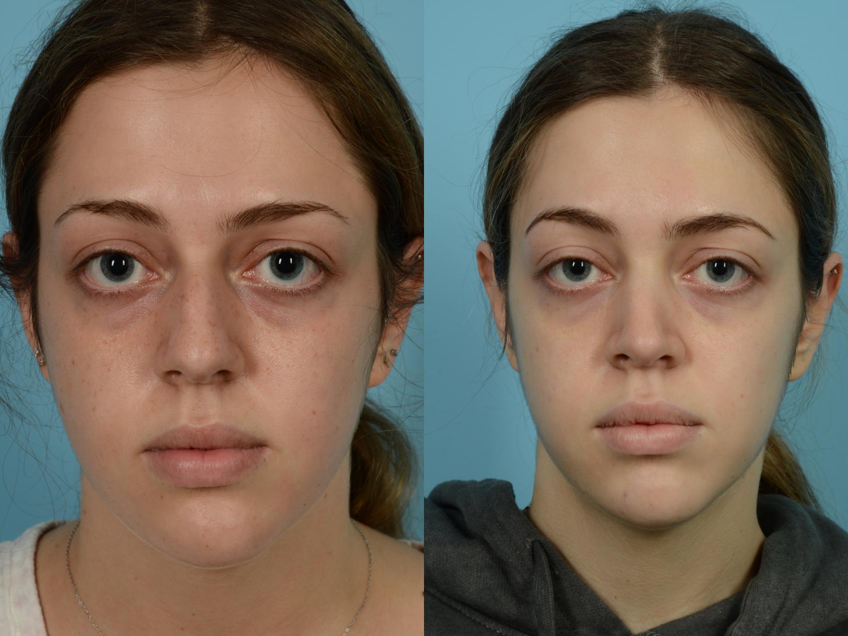 Before & After Rhinoplasty by Dr. Mustoe Case 709 Front View in Chicago, IL