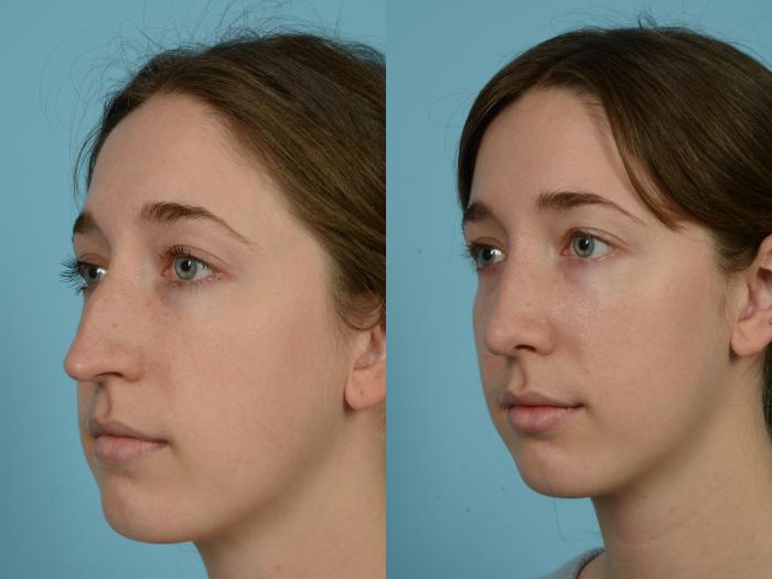 Before & After Rhinoplasty by Dr. Mustoe Case 761 Left Oblique View in Chicago, IL