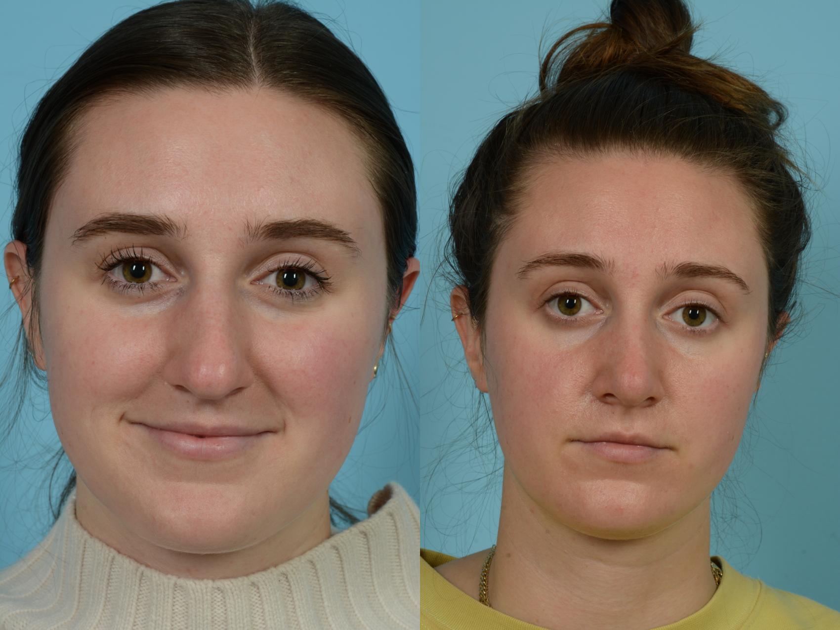 Before & After Rhinoplasty by Dr. Mustoe Case 764 Front View in Chicago, IL