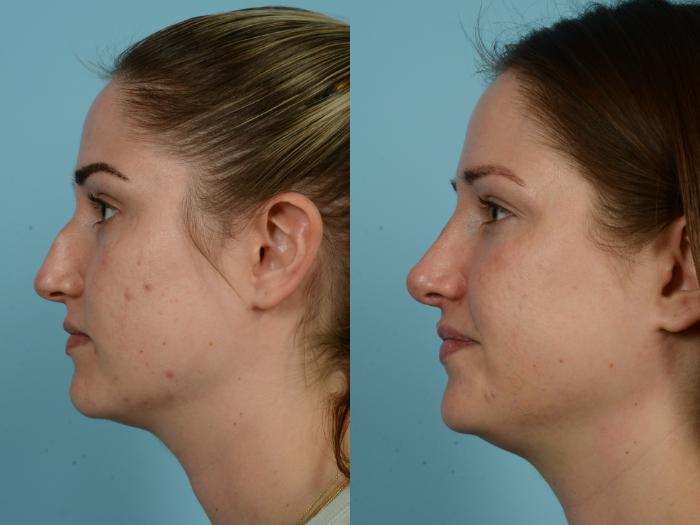 Before & After Rhinoplasty by Dr. Mustoe Case 788 Left Side View in Chicago, IL