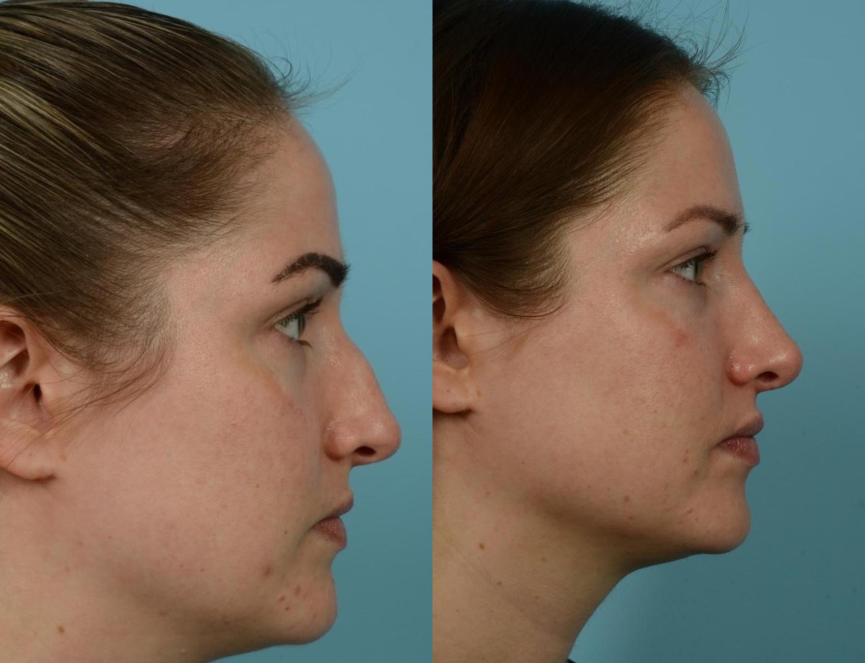 Before & After Rhinoplasty by Dr. Mustoe Case 788 Right Side View in Chicago, IL