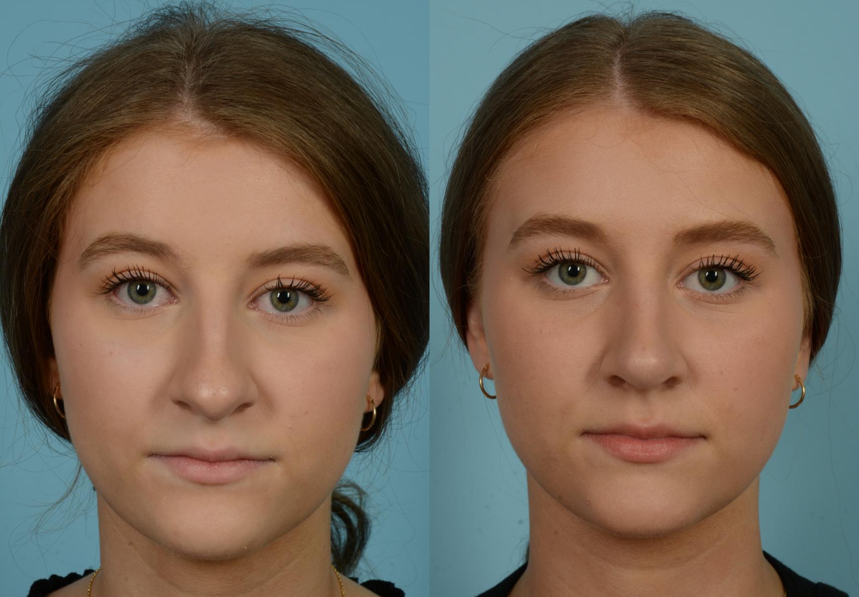 Before & After Rhinoplasty by Dr. Mustoe Case 825 Front View in Chicago, IL
