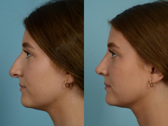 Before & After Rhinoplasty by Dr. Mustoe Case 825 Left Side View in Chicago, IL