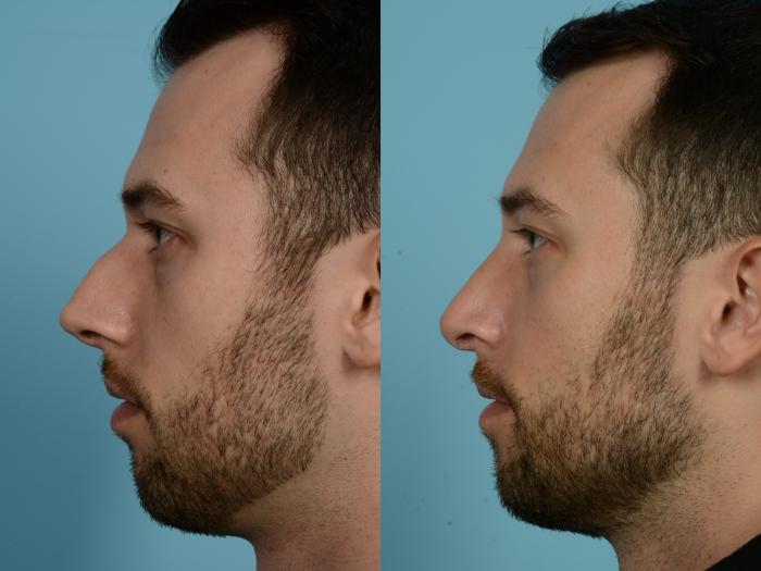 Before & After Rhinoplasty by Dr. Mustoe Case 835 Left Side View in Chicago, IL