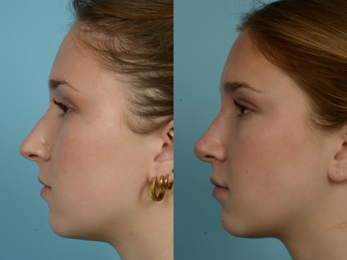 Before & After Rhinoplasty by Dr. Mustoe Case 838 Left Side View in Chicago, IL