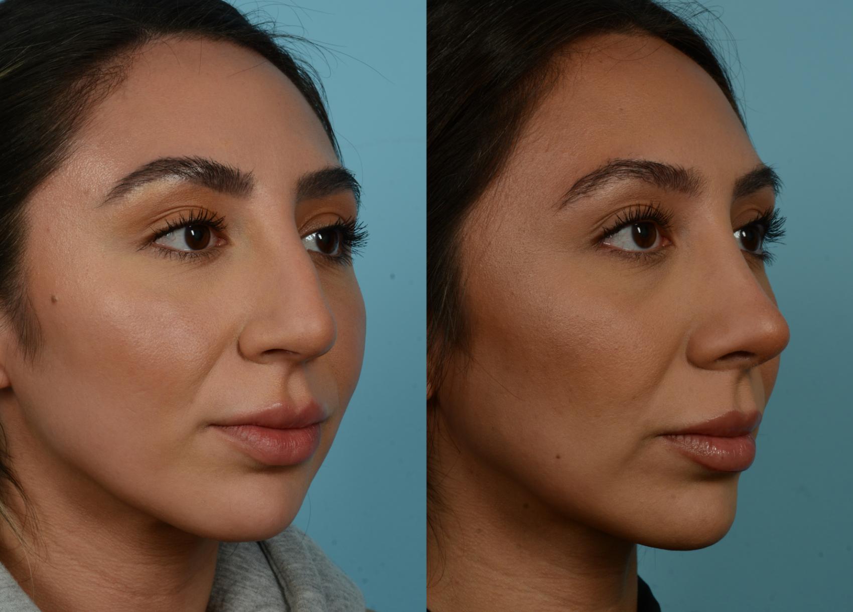 Rhinoplasty By Dr Mustoe Before And After Pictures Case 887 Chicago