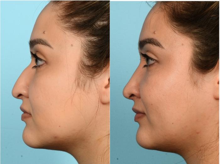 Before & After Rhinoplasty by Dr. Mustoe Case 922 Left Side View in Chicago, IL