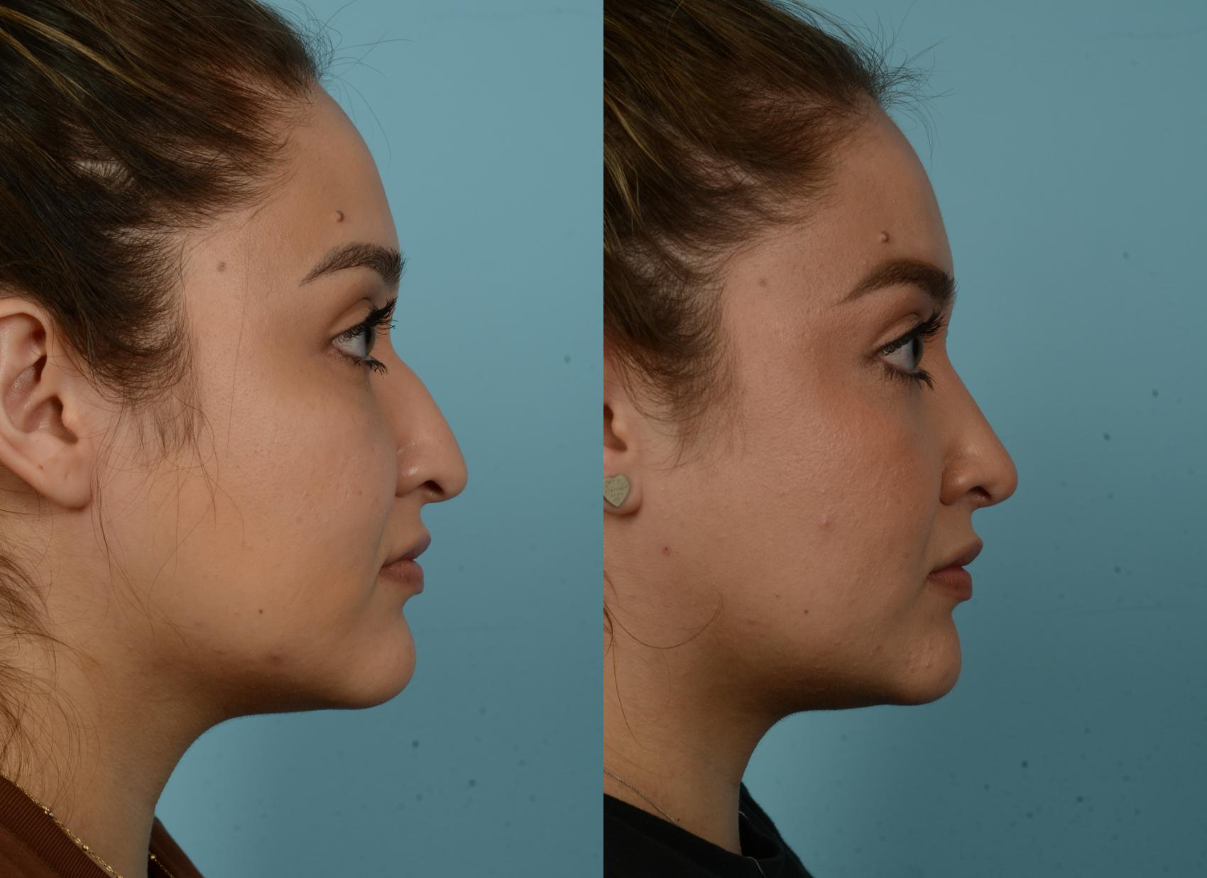 Before & After Rhinoplasty by Dr. Mustoe Case 922 Right Side View in Chicago, IL