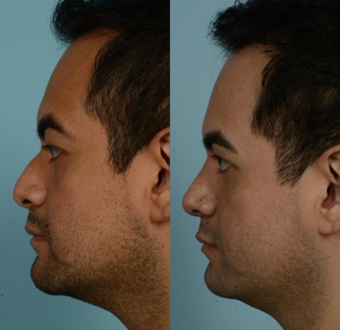 Before & After Rhinoplasty by Dr. Mustoe Case 964 Left Side View in Chicago, IL