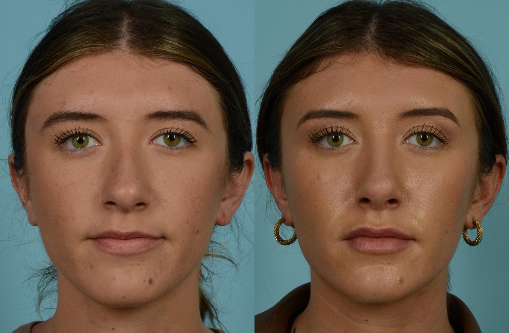 Before & After Rhinoplasty by Dr. Mustoe Case 965 Front View in Chicago, IL