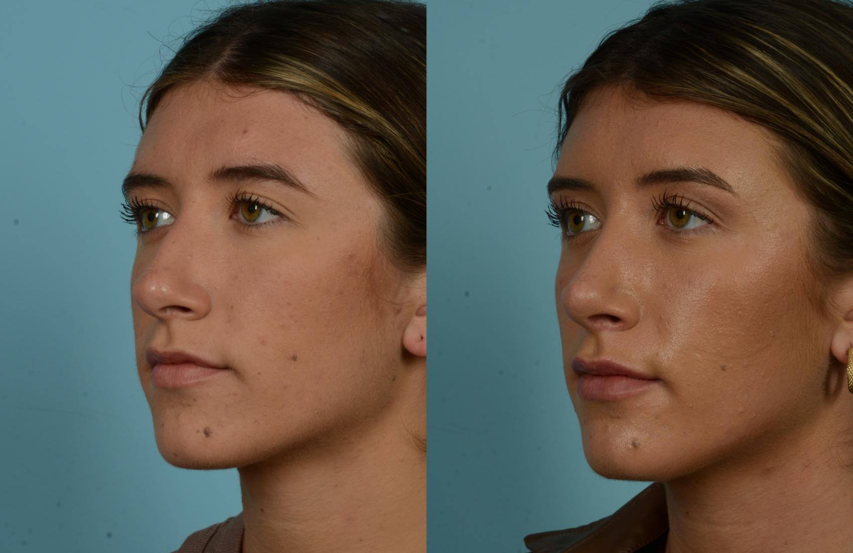 Before & After Rhinoplasty by Dr. Mustoe Case 965 Left Oblique View in Chicago, IL
