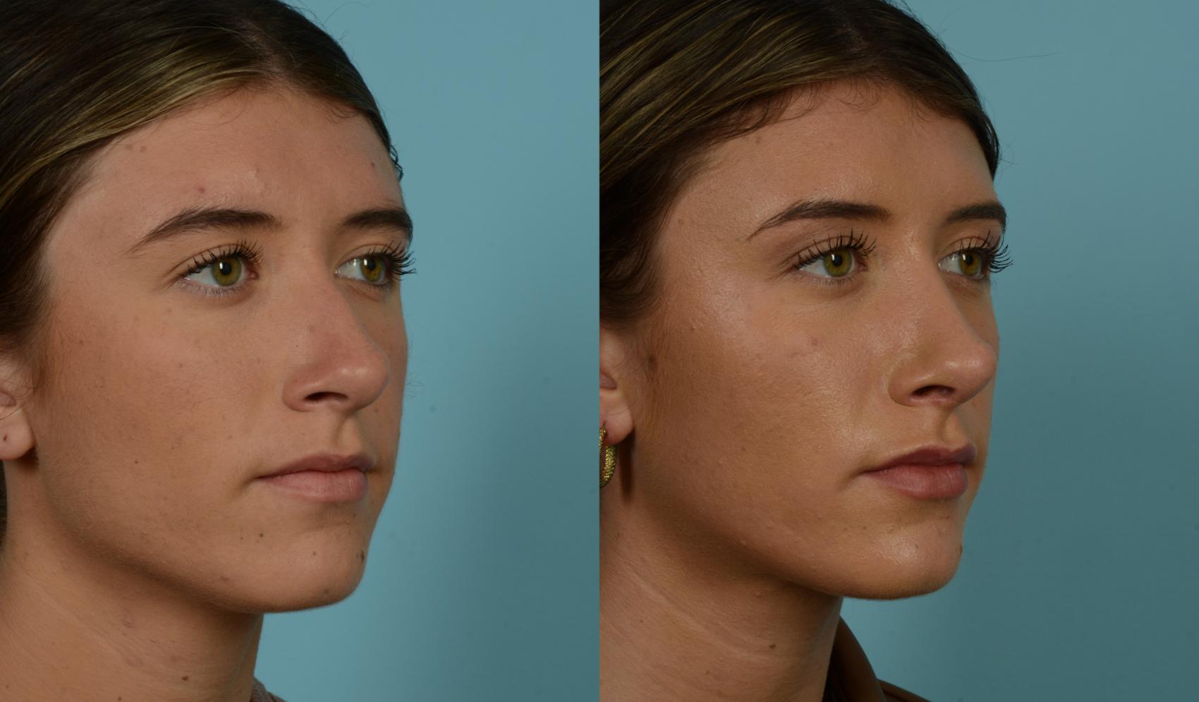 Before & After Rhinoplasty by Dr. Mustoe Case 965 Right Oblique View in Chicago, IL