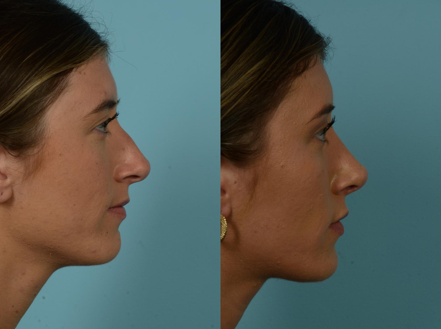 Before & After Rhinoplasty by Dr. Mustoe Case 965 Right Side View in Chicago, IL
