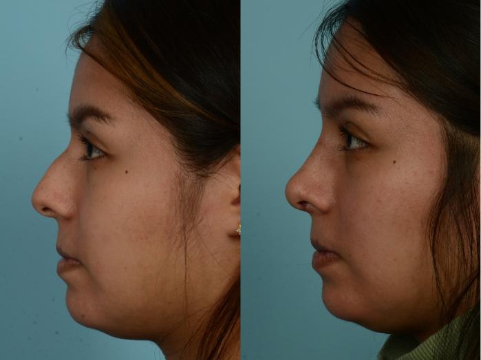 Before & After Rhinoplasty by Dr. Mustoe Case 972 Left Side View in Chicago, IL