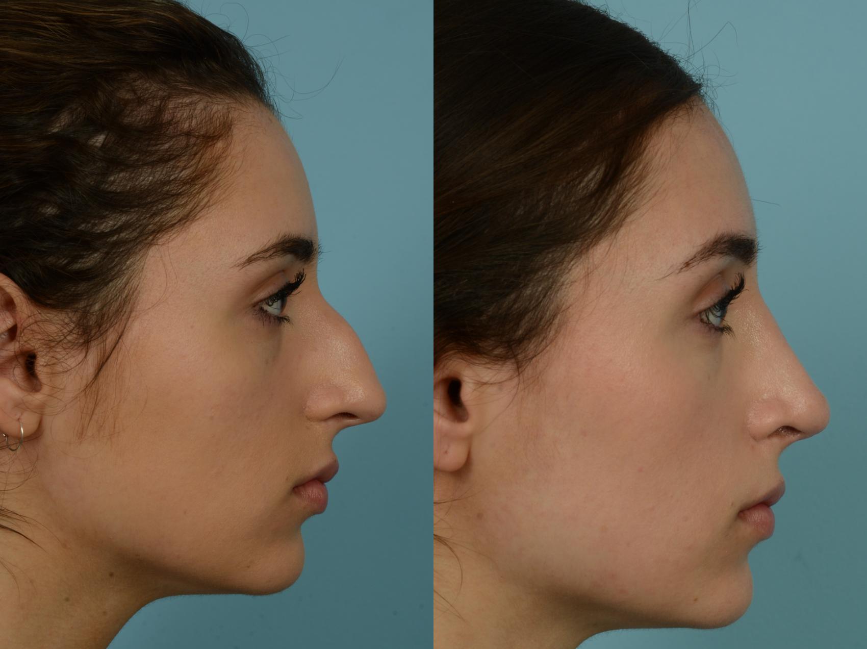 Before & After Rhinoplasty by Dr. Mustoe Case 989 Right Side View in Chicago, IL