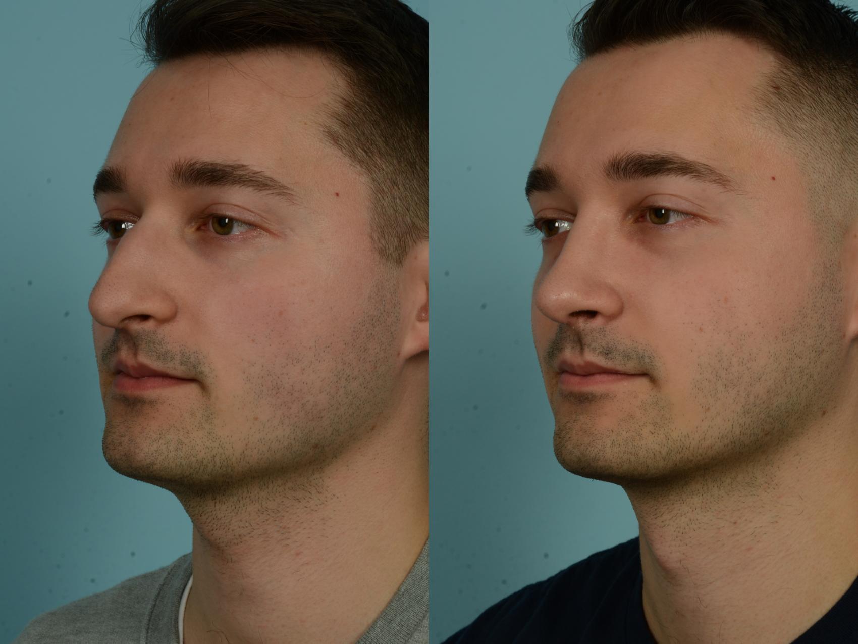 Before & After Rhinoplasty by Dr. Sinno Case 1026 Left Oblique View in Chicago, IL