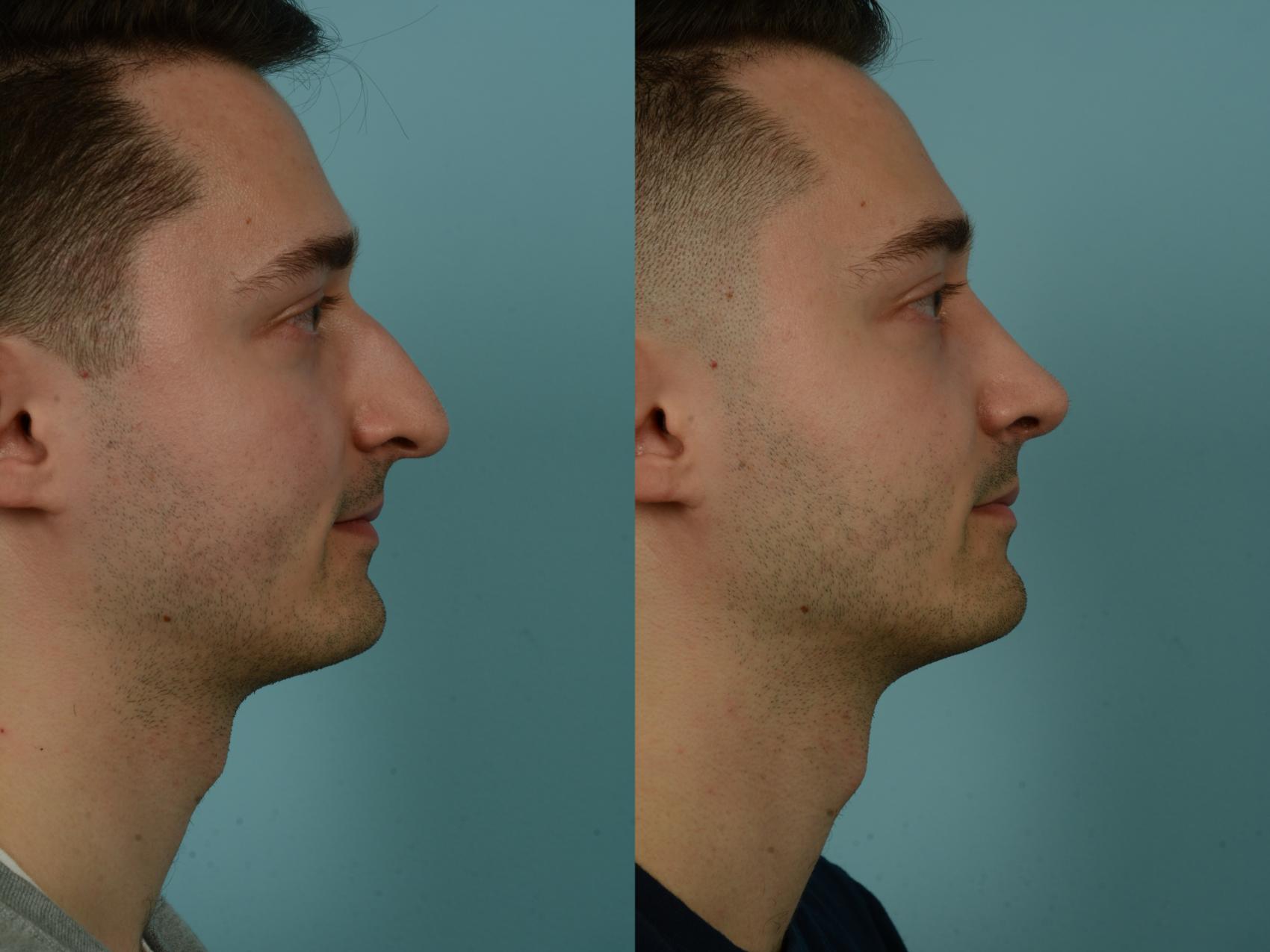Before & After Rhinoplasty by Dr. Sinno Case 1026 Right Side View in Chicago, IL