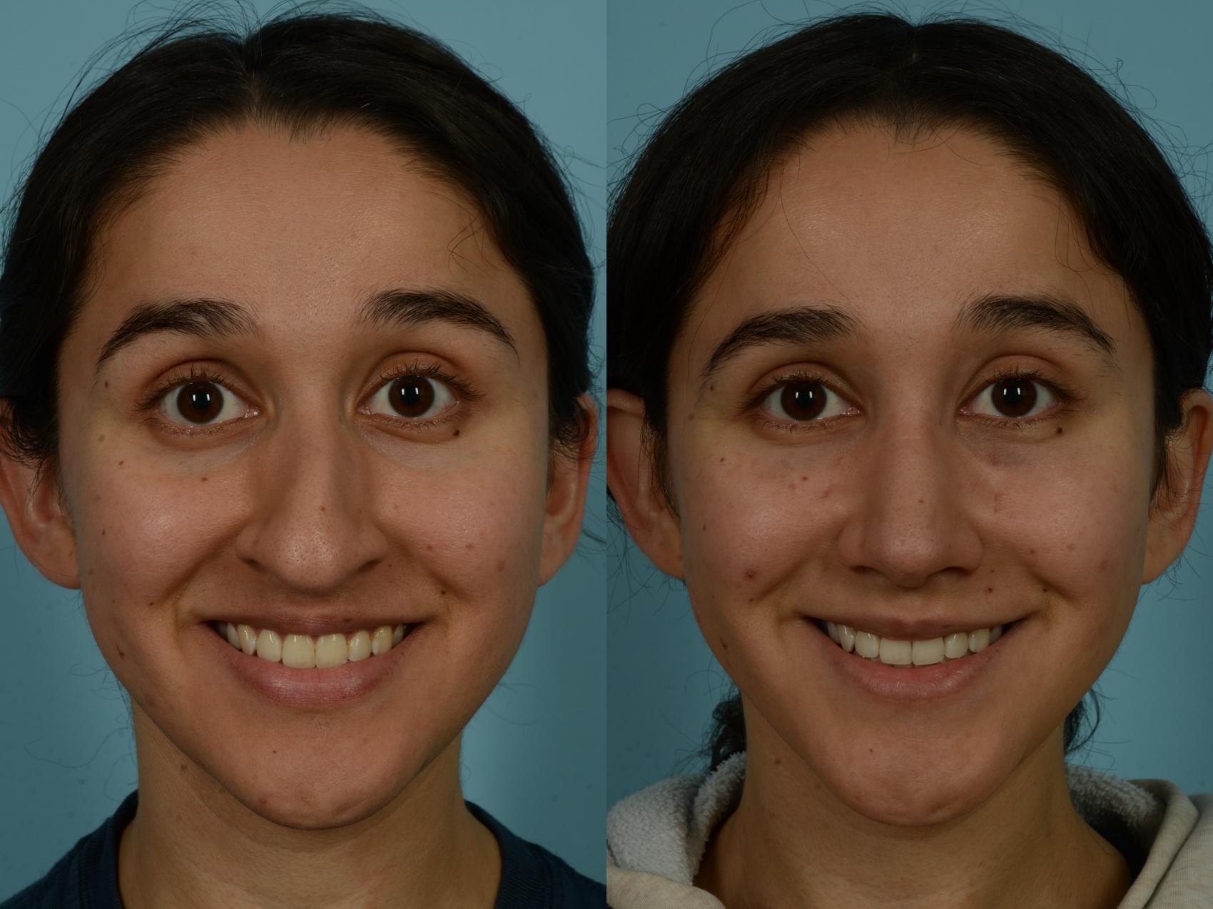 Before & After Rhinoplasty by Dr. Sinno Case 1028 Front View in Chicago, IL