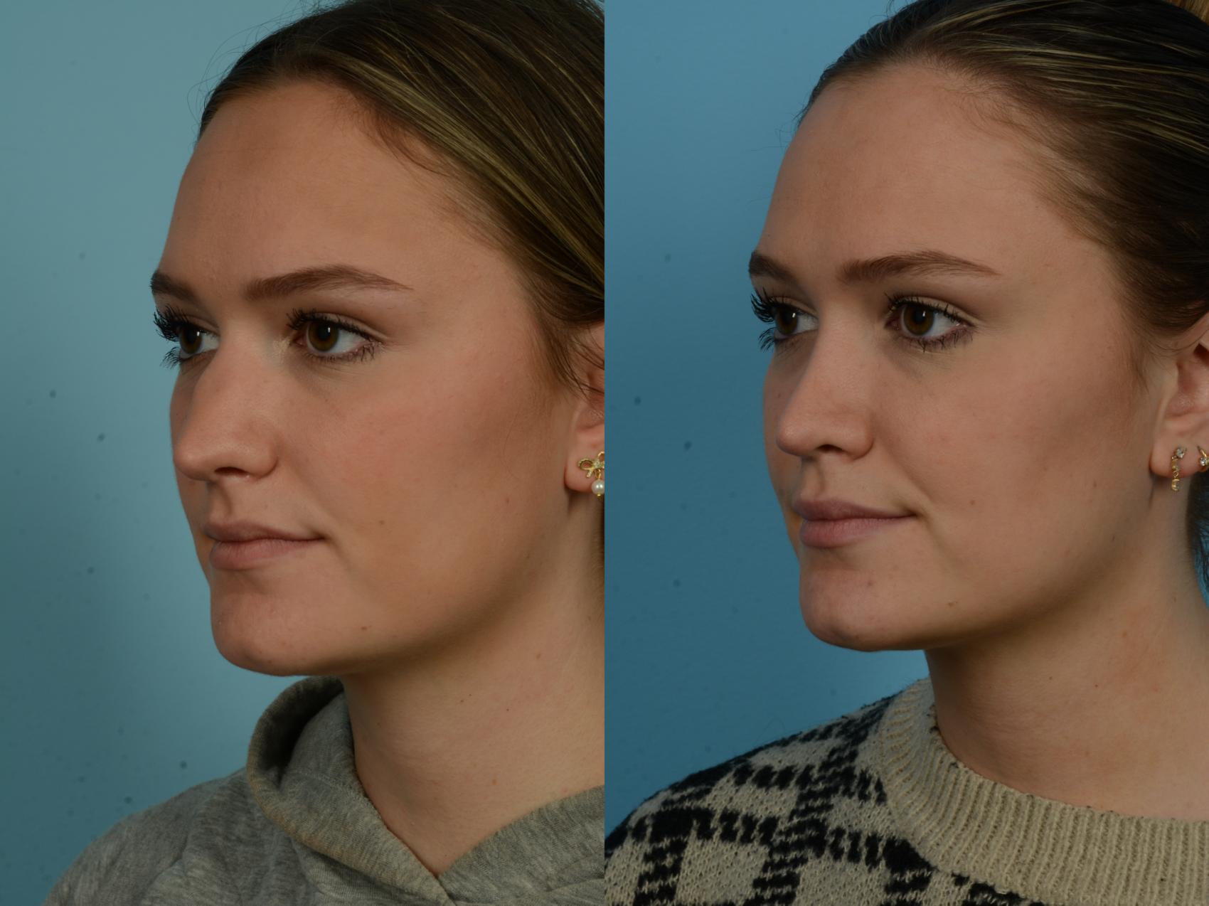Before & After Rhinoplasty by Dr. Sinno Case 1045 Left Oblique View in Chicago, IL